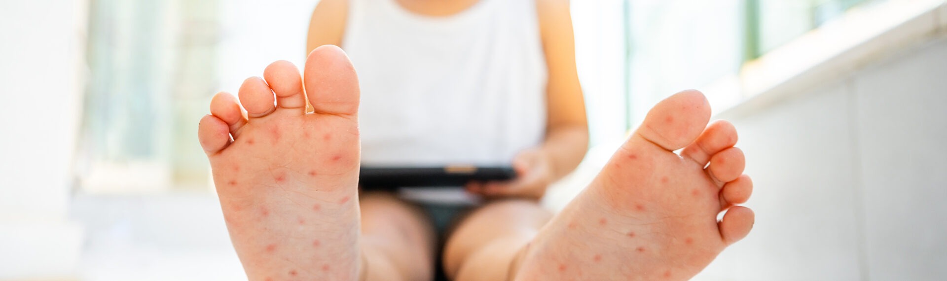 Kind sitzt auf dem Boden und hält ein Tablet, während seine Fußsohlen mit roten Hautausschlägen übersät sind.