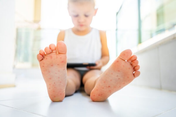 Kind sitzt auf dem Boden und hält ein Tablet, während seine Fußsohlen mit roten Hautausschlägen übersät sind.