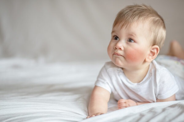 Ein Baby sitz auf einen weißen Bett. Es hat sichtbar rote Bäckchen vom Zahnen.