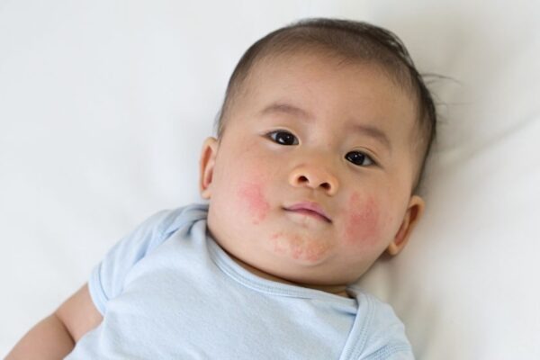 Baby mit sanftem Hautausschlag auf der Wange
