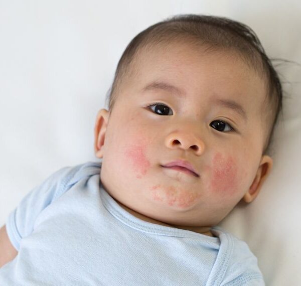 Baby mit sanftem Hautausschlag auf der Wange