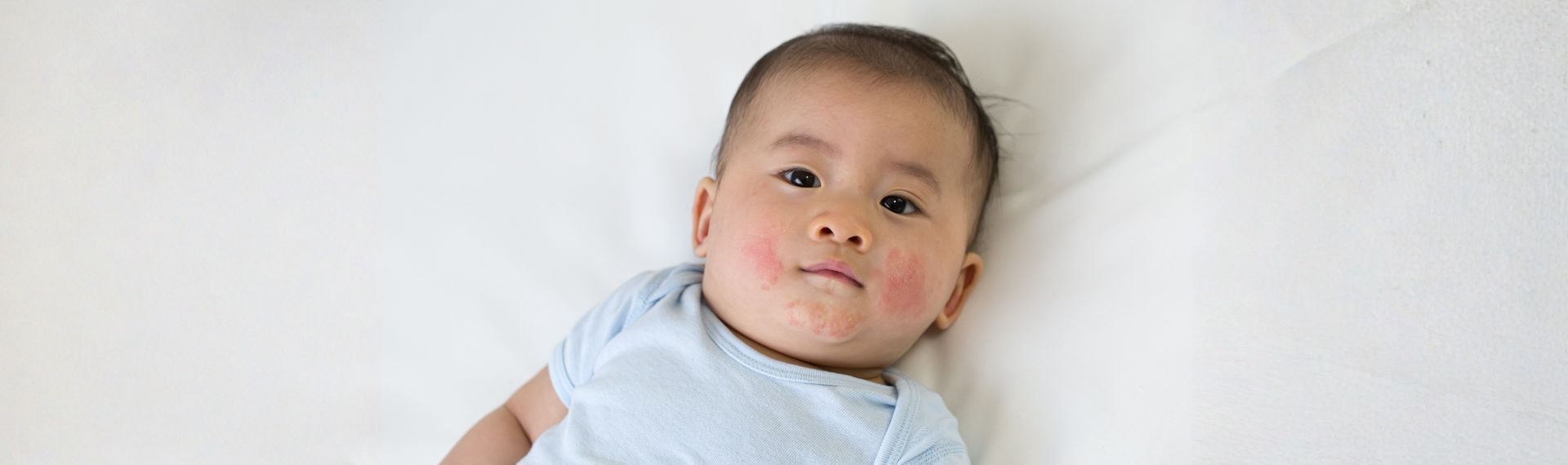 Baby mit sanftem Hautausschlag auf der Wange